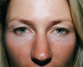 Feel Beautiful - Eyelid Surgery San Diego Case 41 - Before Photo